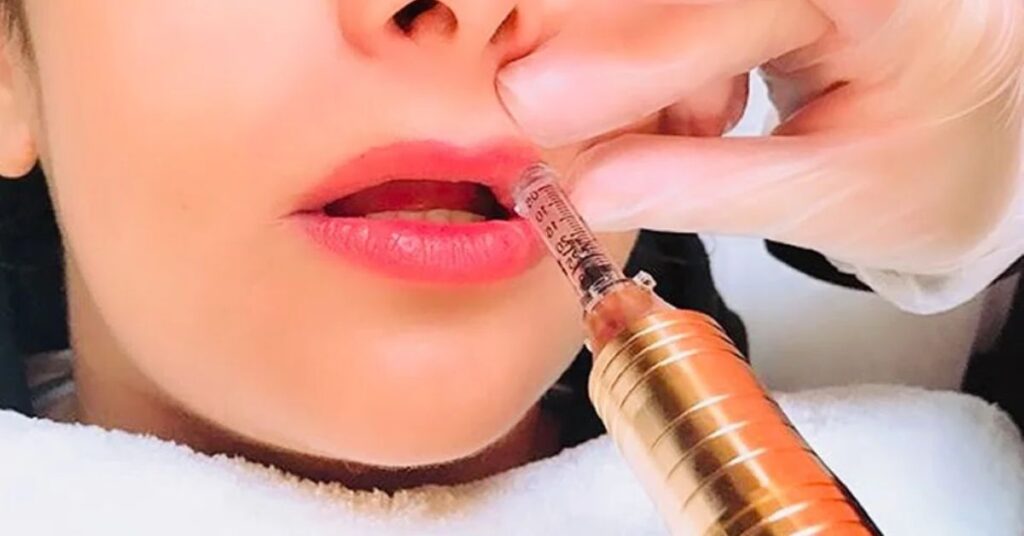 Why Has Butterfly Lip Filler Become So Popular?